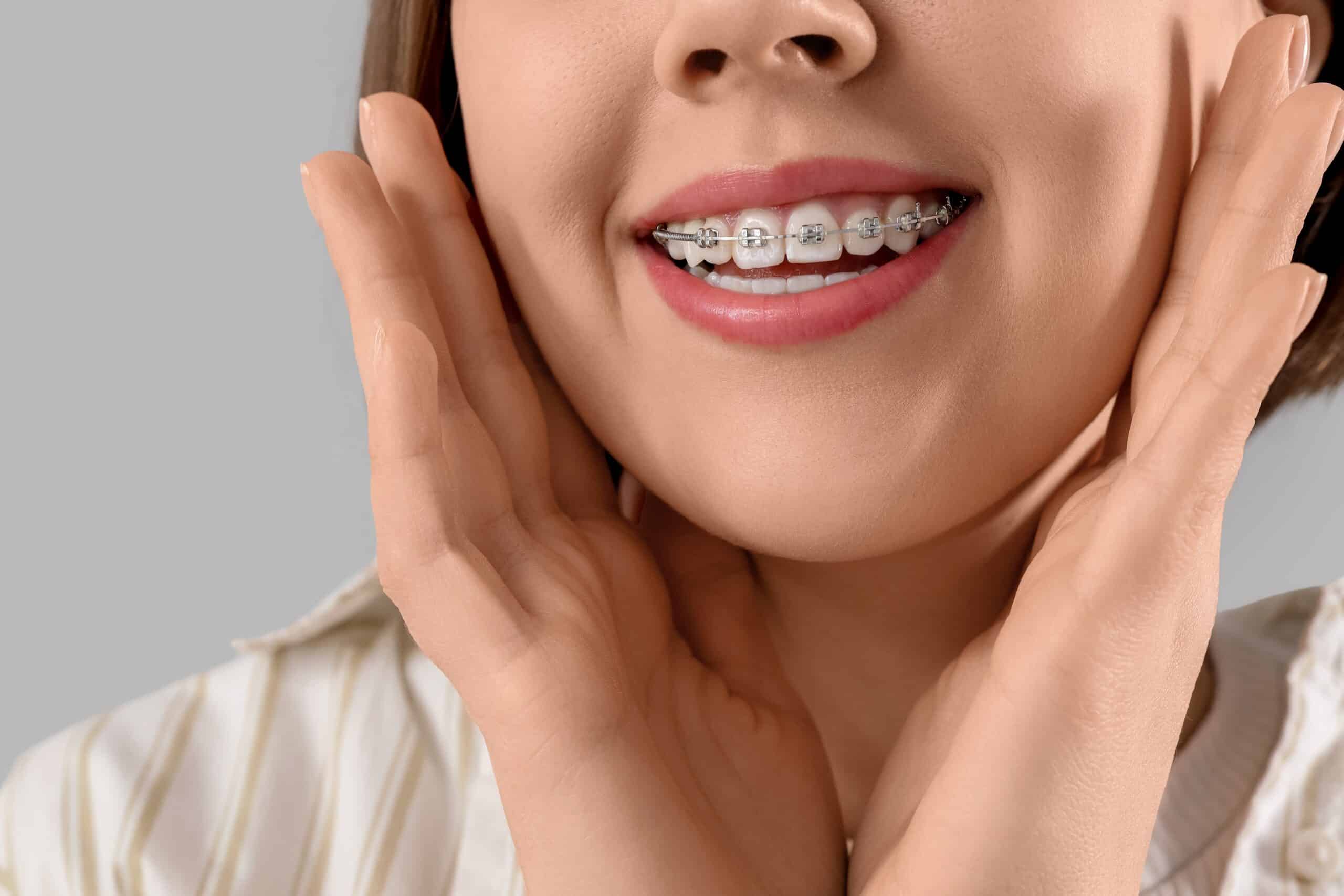 Young,Woman,With,Dental,Braces,On,Light,Background,,Closeup